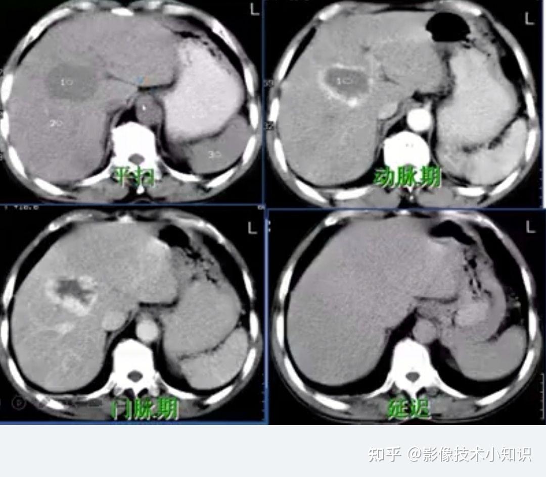 肝海绵状血管瘤的影像诊断
