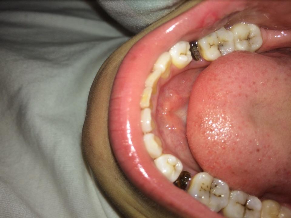 龋齿虫牙是怎么产生的为什么患病率这么高