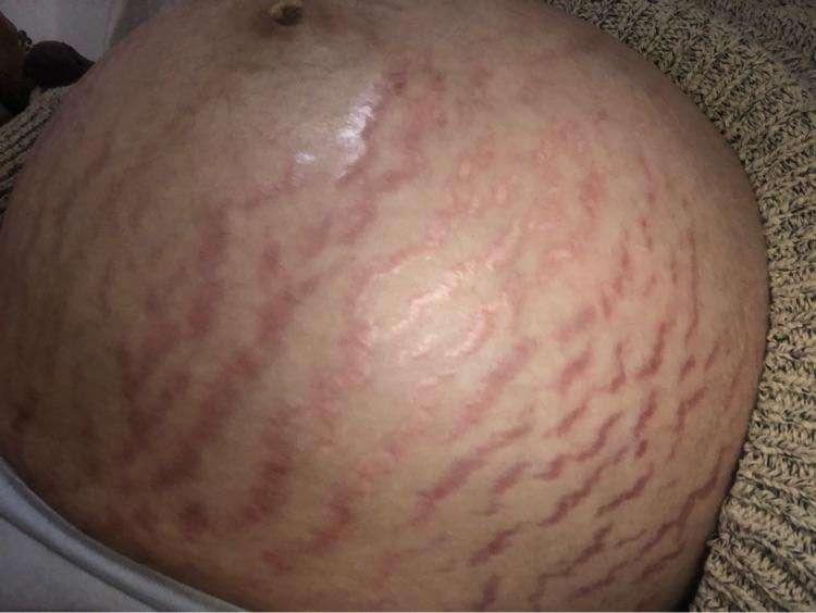 妊娠纹竟然跟肥胖纹长得一样!到底如何预防妊娠纹啊!