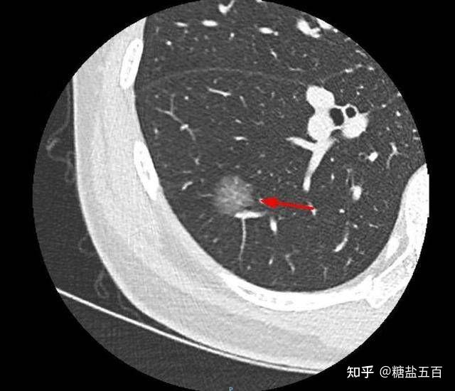 肺部磨玻璃结节groundglassnoduleggn的再认识