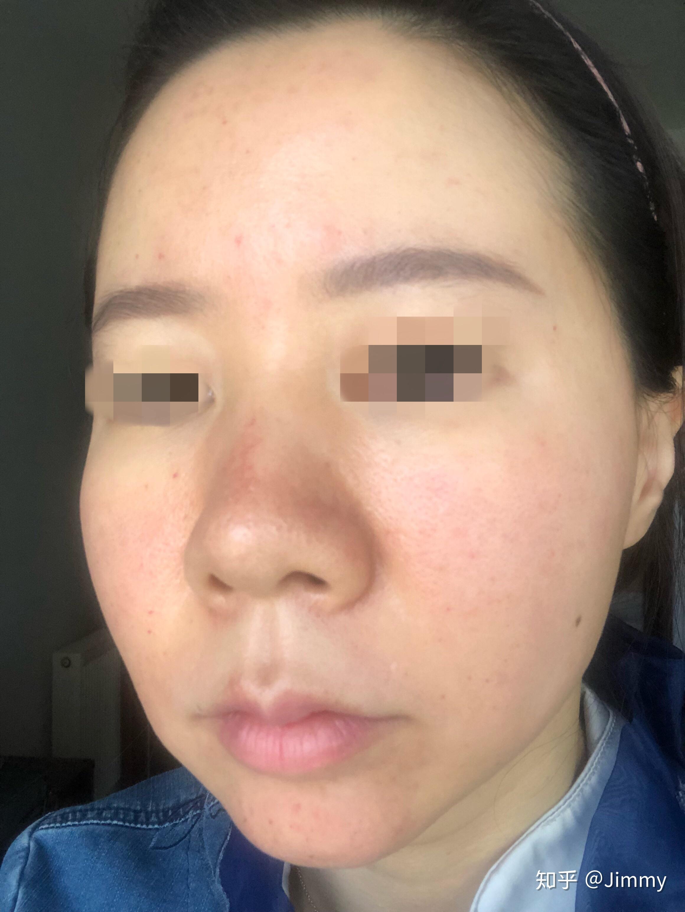 韩国露飞ruffy婴儿针