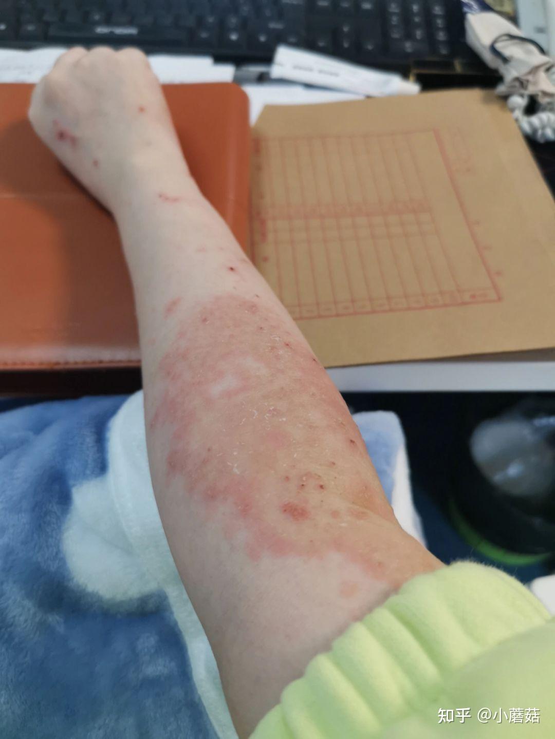 慢性湿疹可以根治吗三四年的湿疹怎么治