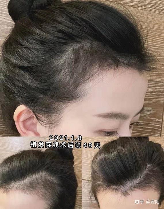 发量少植发密度(植发的密度和正常头发的密度)