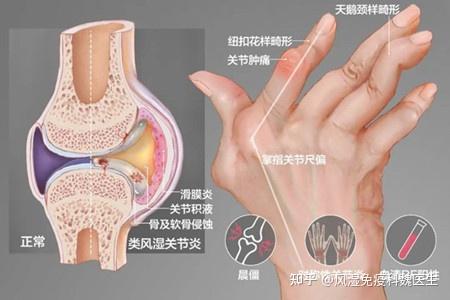 类风湿关节炎有些方面你误会它了