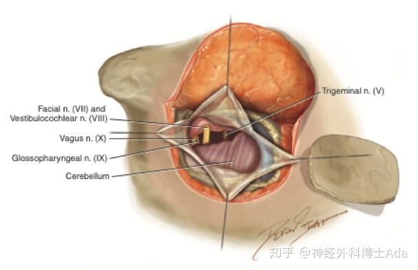 听神经瘤三大手术要点图解 经迷路后入路