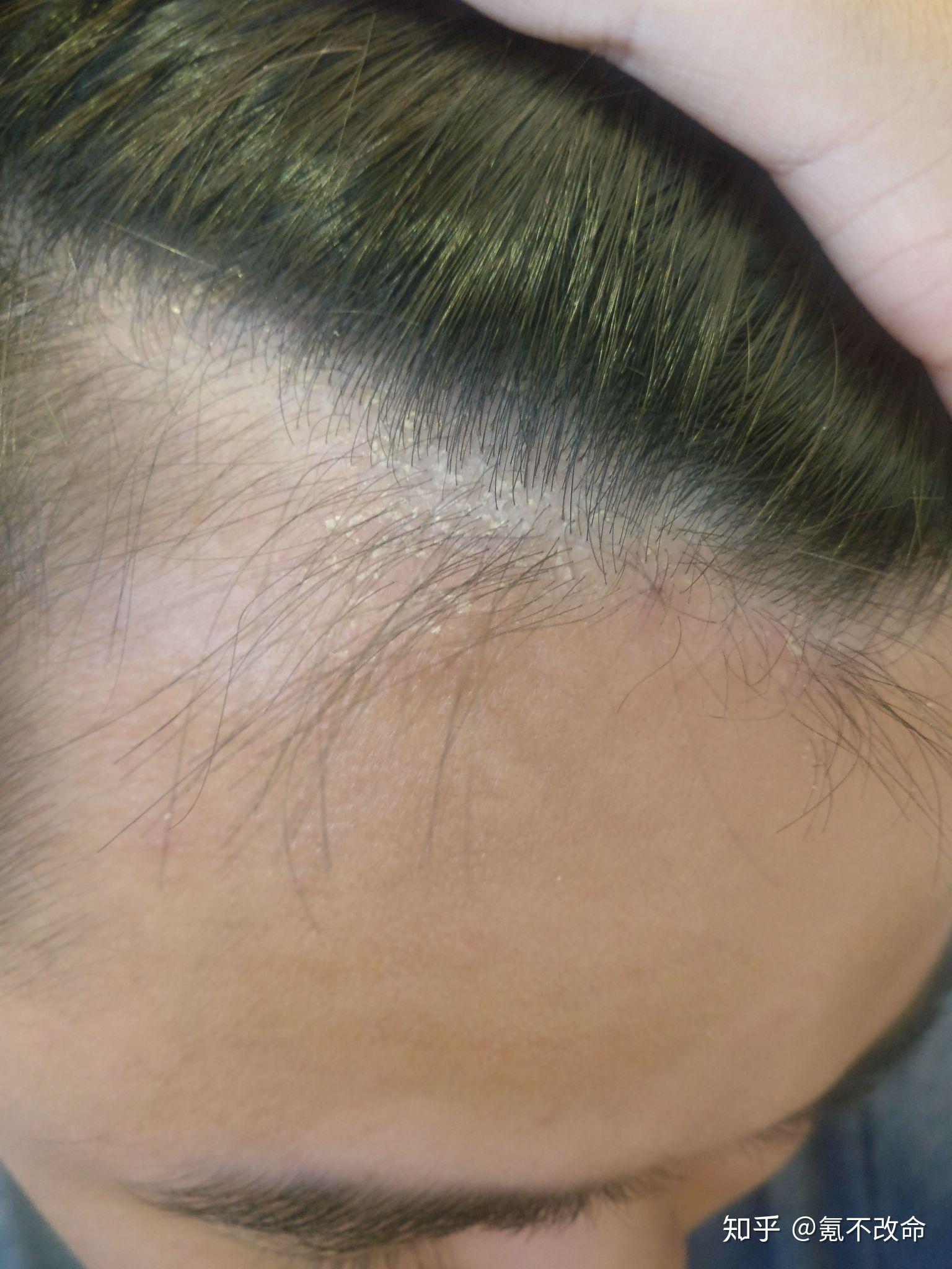 大块大块地掉头皮屑,有什么好用的男士去屑洗发水推荐? - 知乎