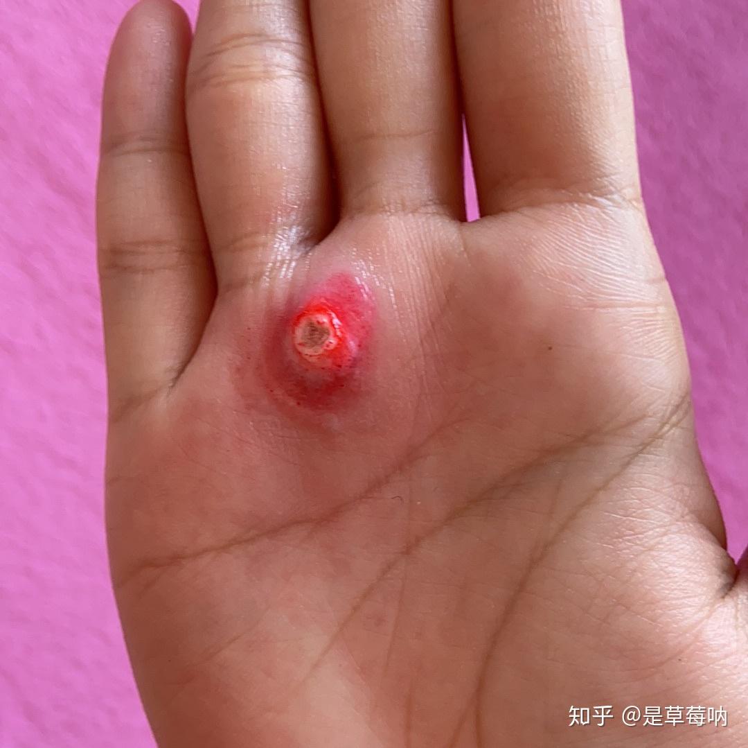 自己治好了瘊子