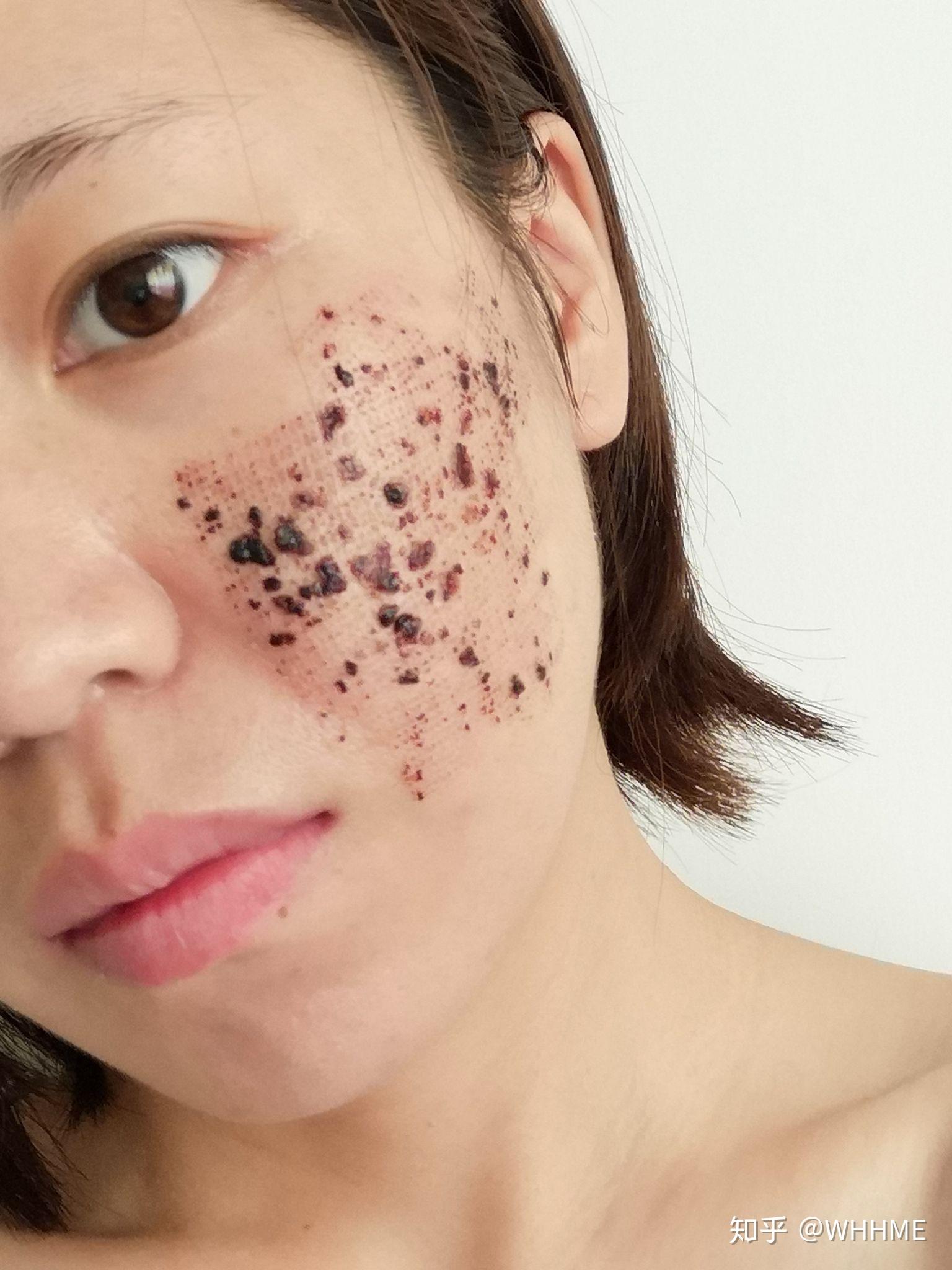 点阵激光去痘坑