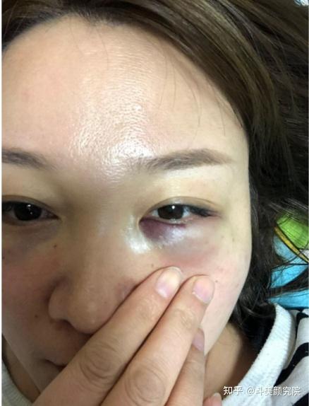 发黑,甚至会加重你的黑眼圈,这种情况也就是常说的"丁达尔"
