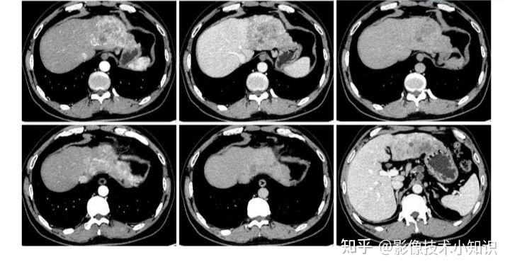 肝癌ct片图片图片