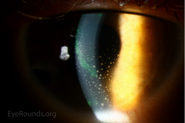 葡萄膜炎你竟如此不同一篇关于葡萄膜炎包括虹膜炎的正经科普