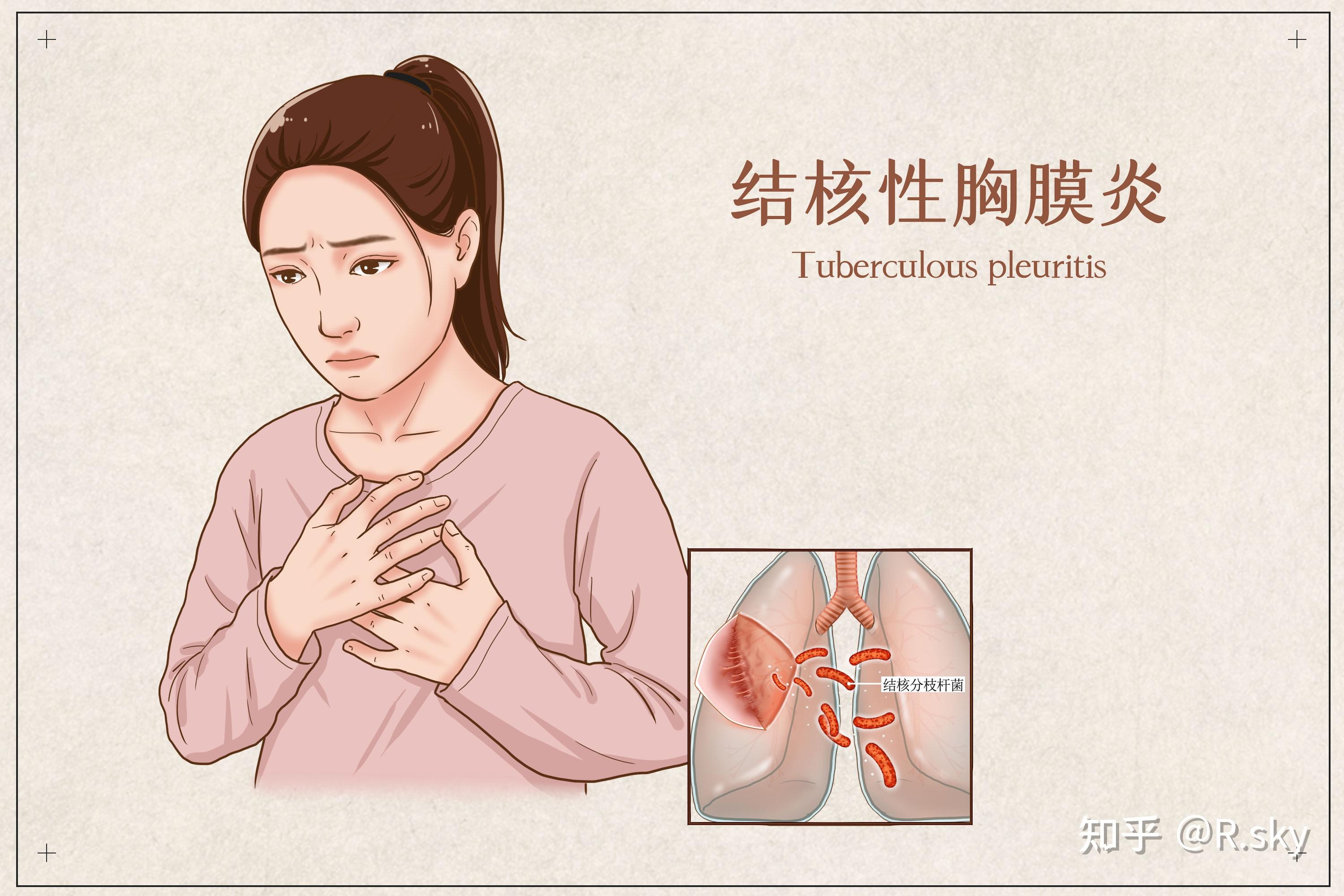 胸膜炎的早期症状图片