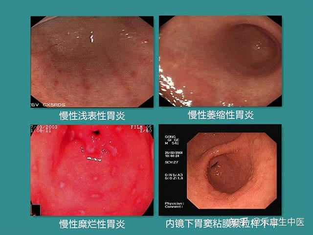 中医认为,该病是由浅表性胃炎或其他慢性胃炎经过比较漫长病程进展