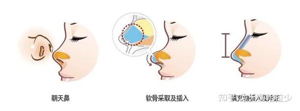 朝天鼻、鼻孔外露你中招了吗? - 知乎