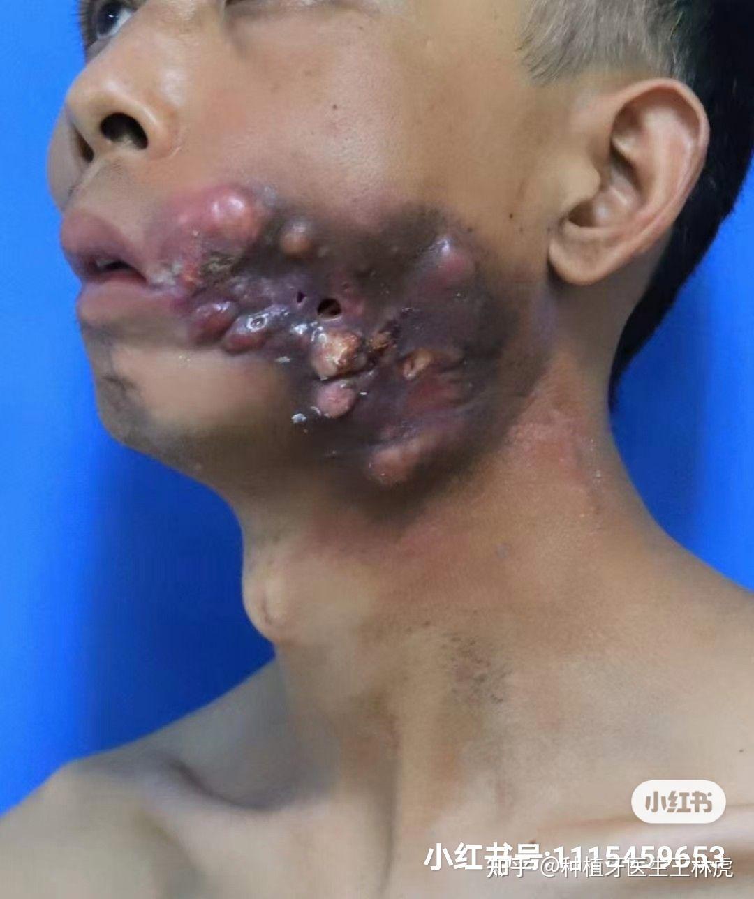 槟榔的危害口腔图片