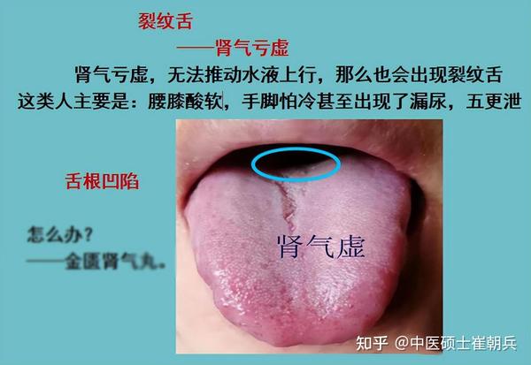 舌头有裂纹?5种原因,9种舌象,看看你是属于哪一种? - 知乎