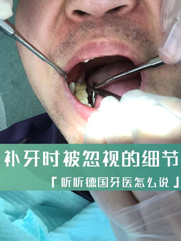 纯知识 | 补牙材料怎么选?补牙时容易被忽视的细节 - 知乎