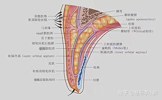 轻度---释放眶隔脂肪并祛除,再祛除外侧roof层(轮匝肌后脂肪);中度