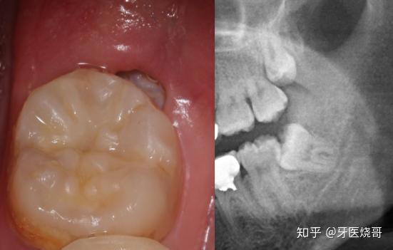 當免疫力下降時,就會經常發炎,甚至殘渣堵塞,刺激引起盲袋,冠周炎發作