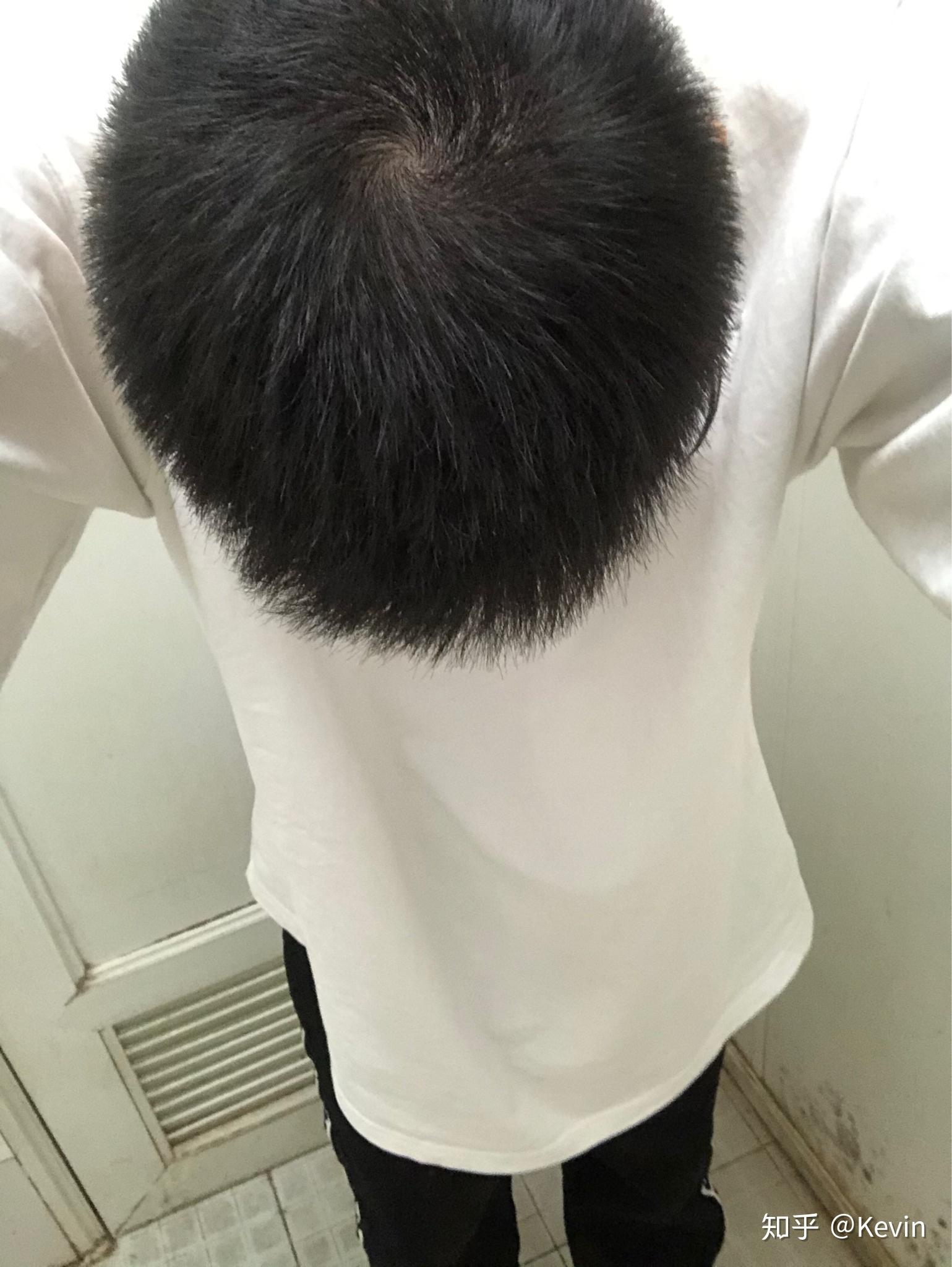 非那雄胺九个月效果 - 知乎