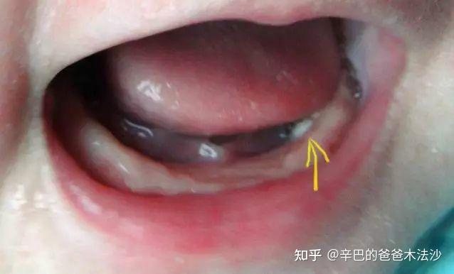 黄疸吐奶o型腿新生儿常见的异常现象不必担心更别瞎治疗
