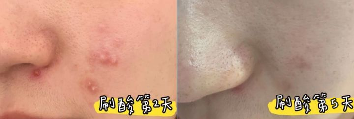 【最正确的刷酸教程】脸上狂出油|痘痘|闭口、粉刺、黑头疯长|毛孔粗大成“毛坑”|到底刷酸怎么刷才能安全有效地解决这些问题?医学博士分享小白也能 ...