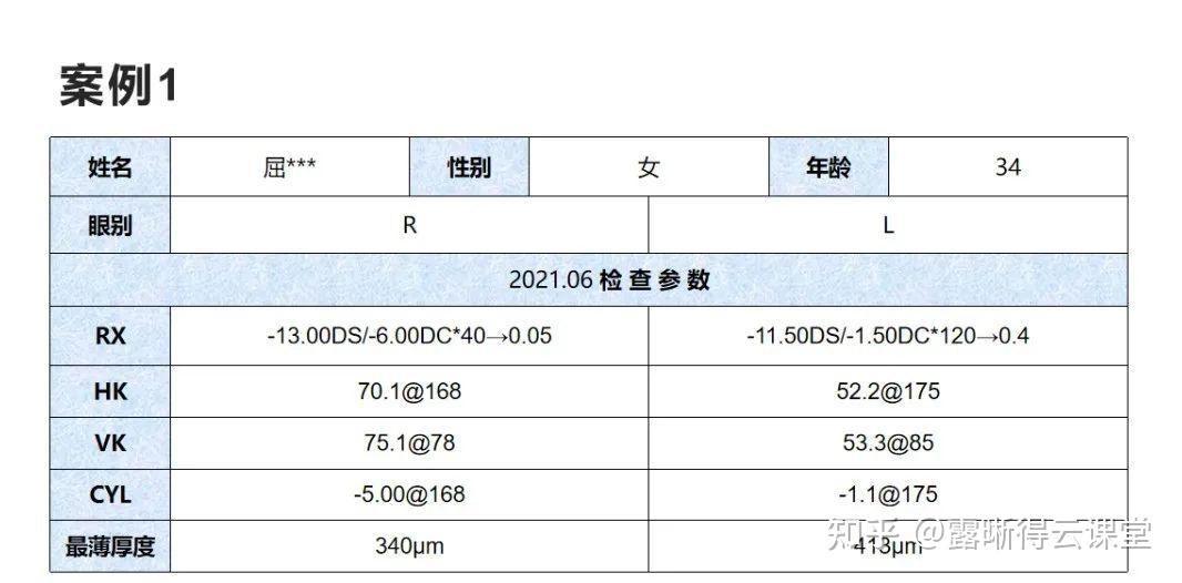 圆锥角膜的RGP验配及RGP临床效果分析（文字版） - 知乎