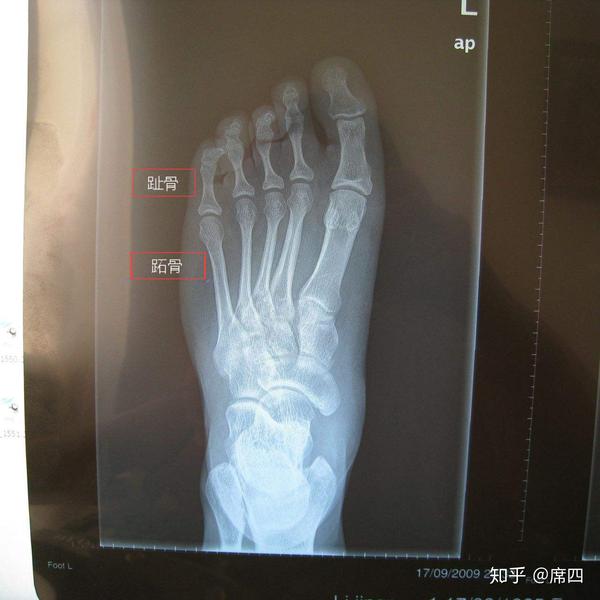 第四足趾短小?短趾症 知乎 第四足趾短小?短趾症 知乎