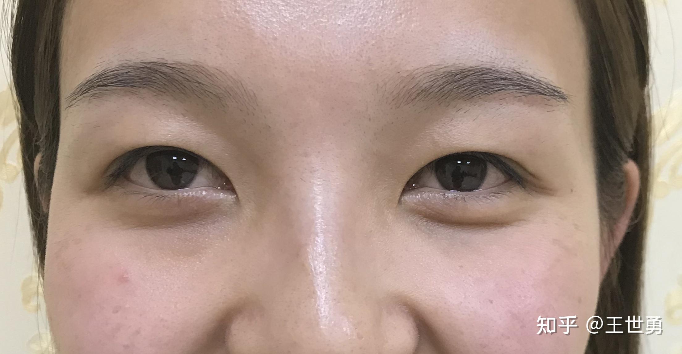 这位求美者之前做过埋线双眼皮,现在双眼皮已经看不到,显老,要求解决.