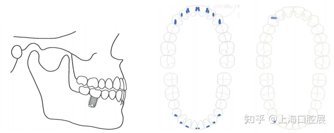 对于后牙种植单冠而言,应形成用尖-卵圆窝面接触,以减小侧向力.