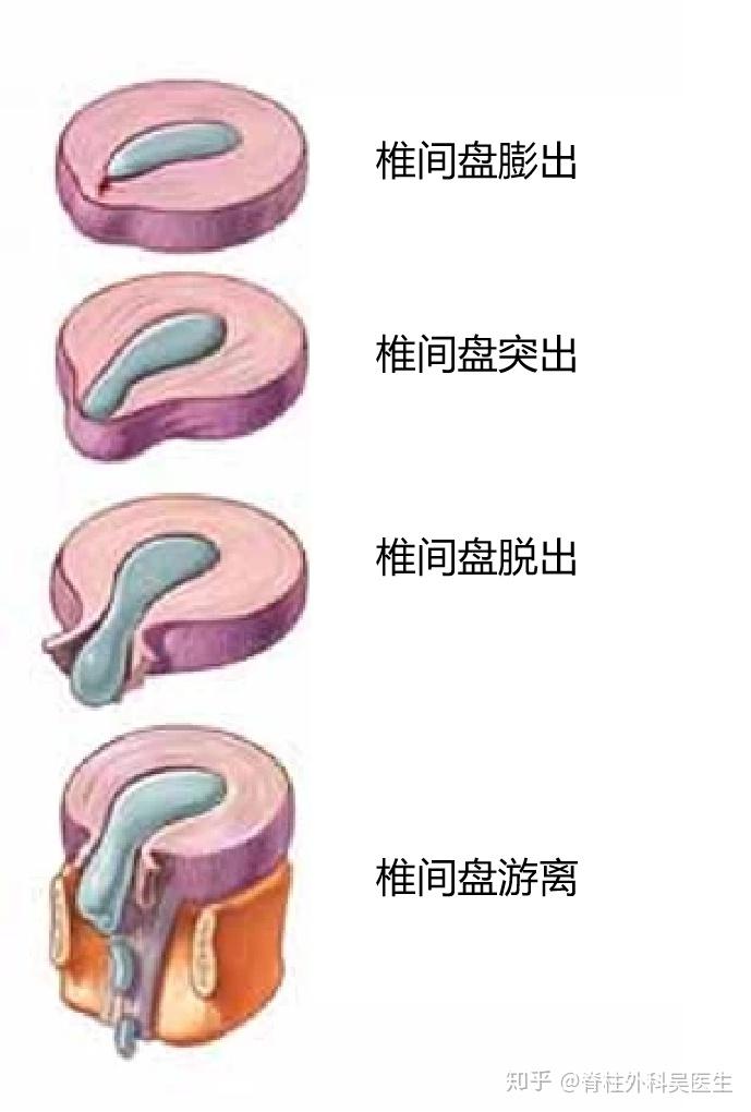 腰椎间盘突出症 8种最佳自我锻炼方式 知乎