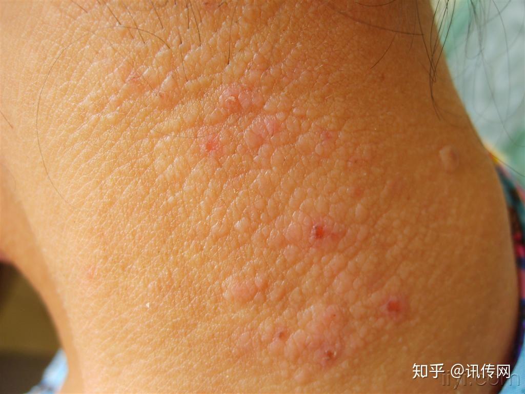 神经性皮炎到底是怎么回事? - 知乎