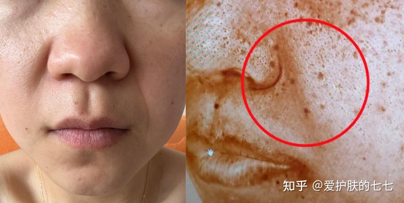 从医学角度来说,普通人去法令纹最有效且低成本的方法是什么? - 知乎