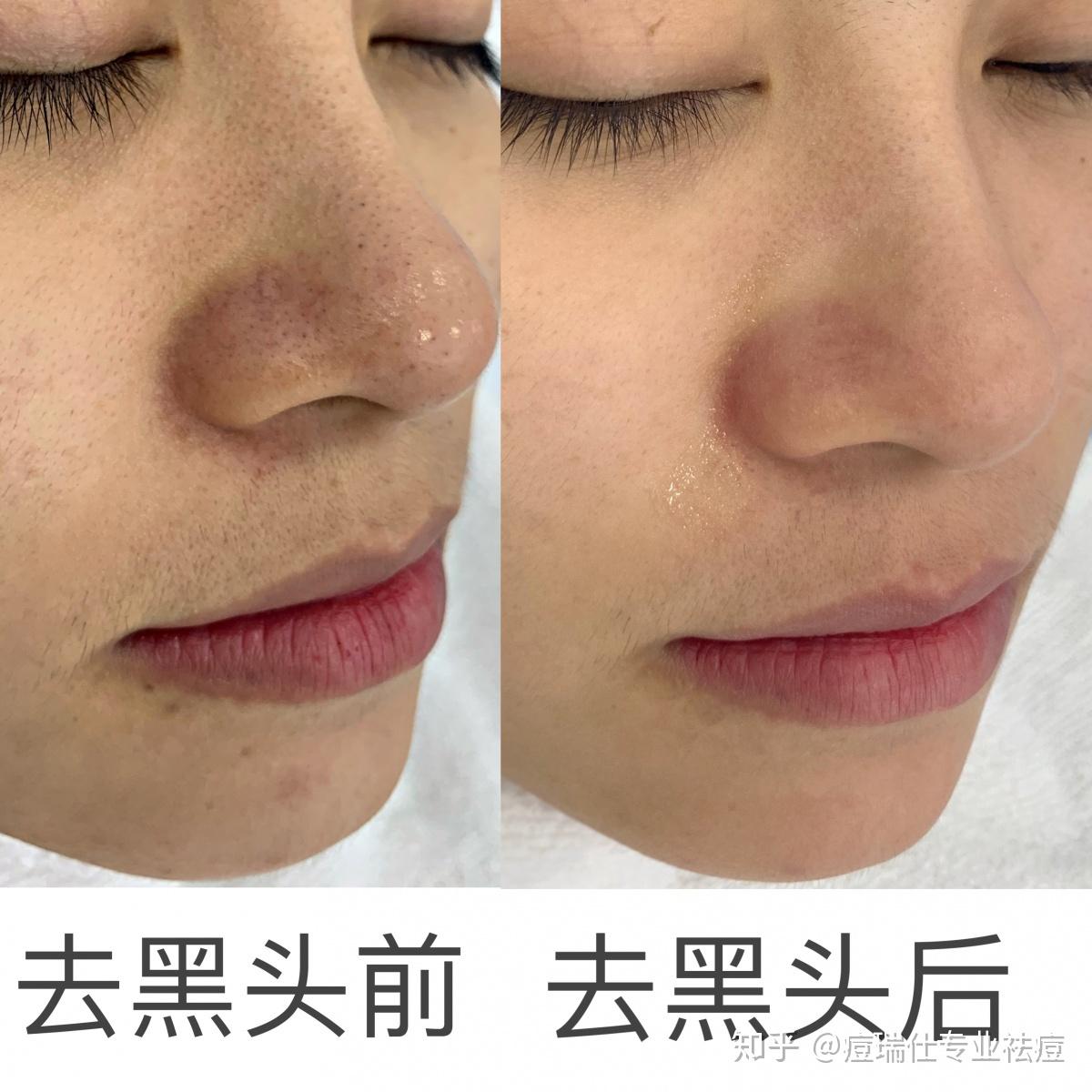 一次见效的爆红祛黑头方法亲测有效