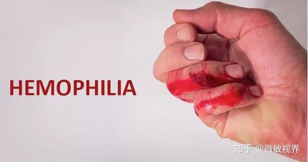 严重凝血障碍的遗传性出血性疾病血友病