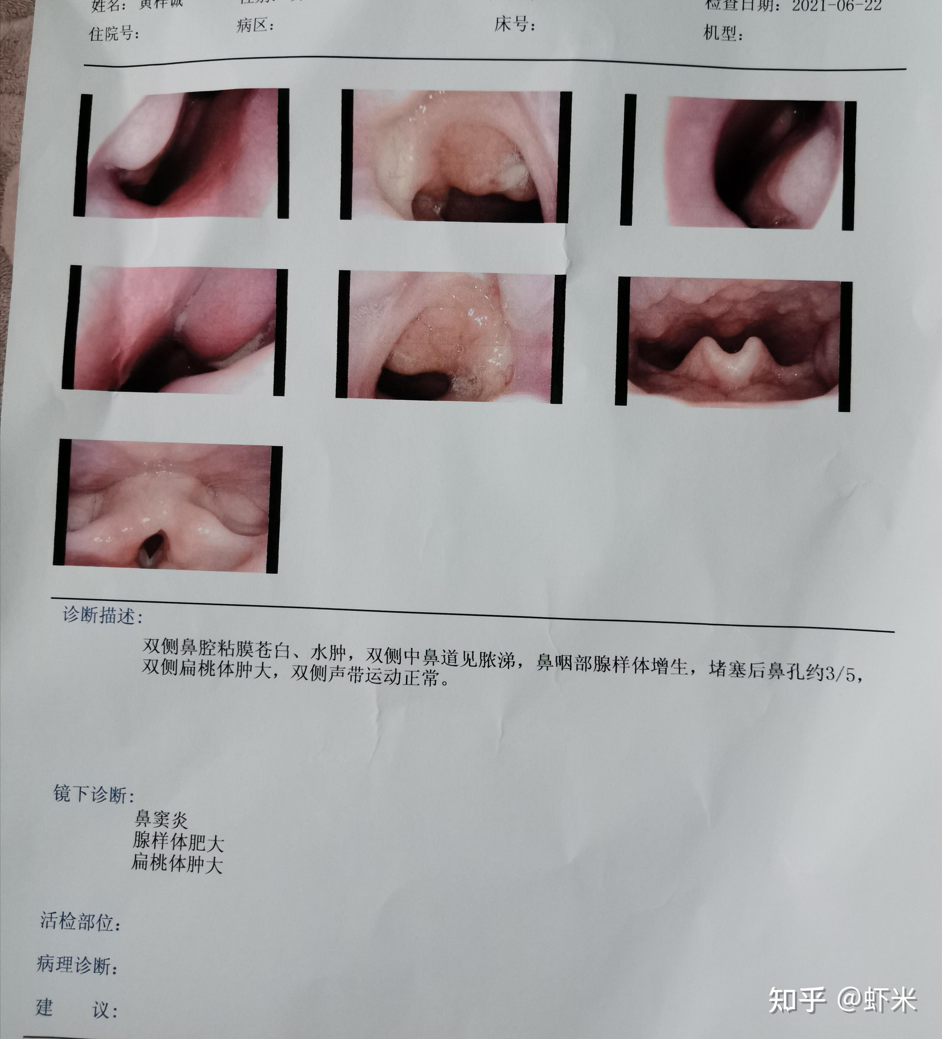 鼻窦肿大后果图片图片