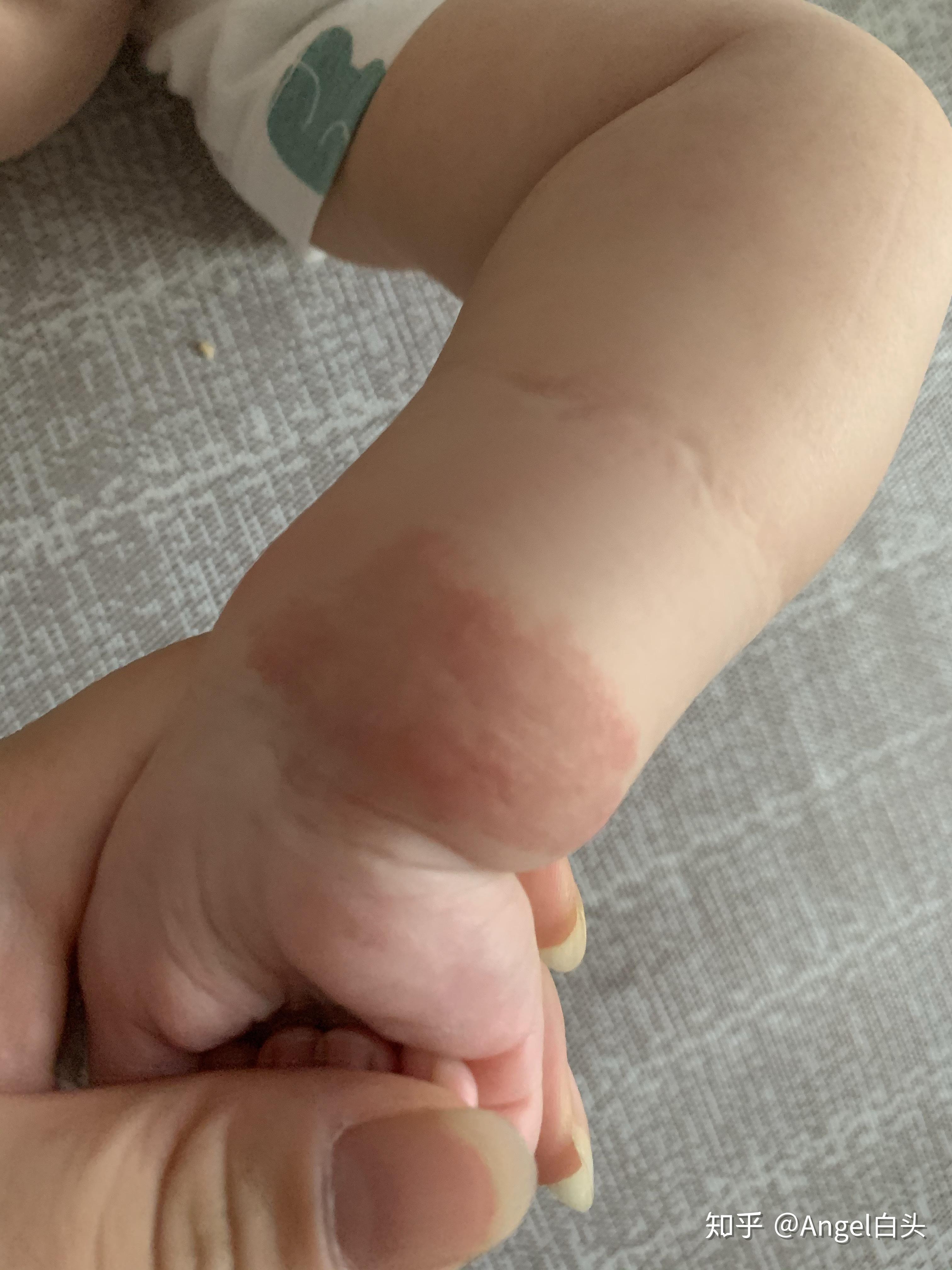 了,就是一定要坚持,记得每次半小时或者一个小时就好了,不然会长痱子!