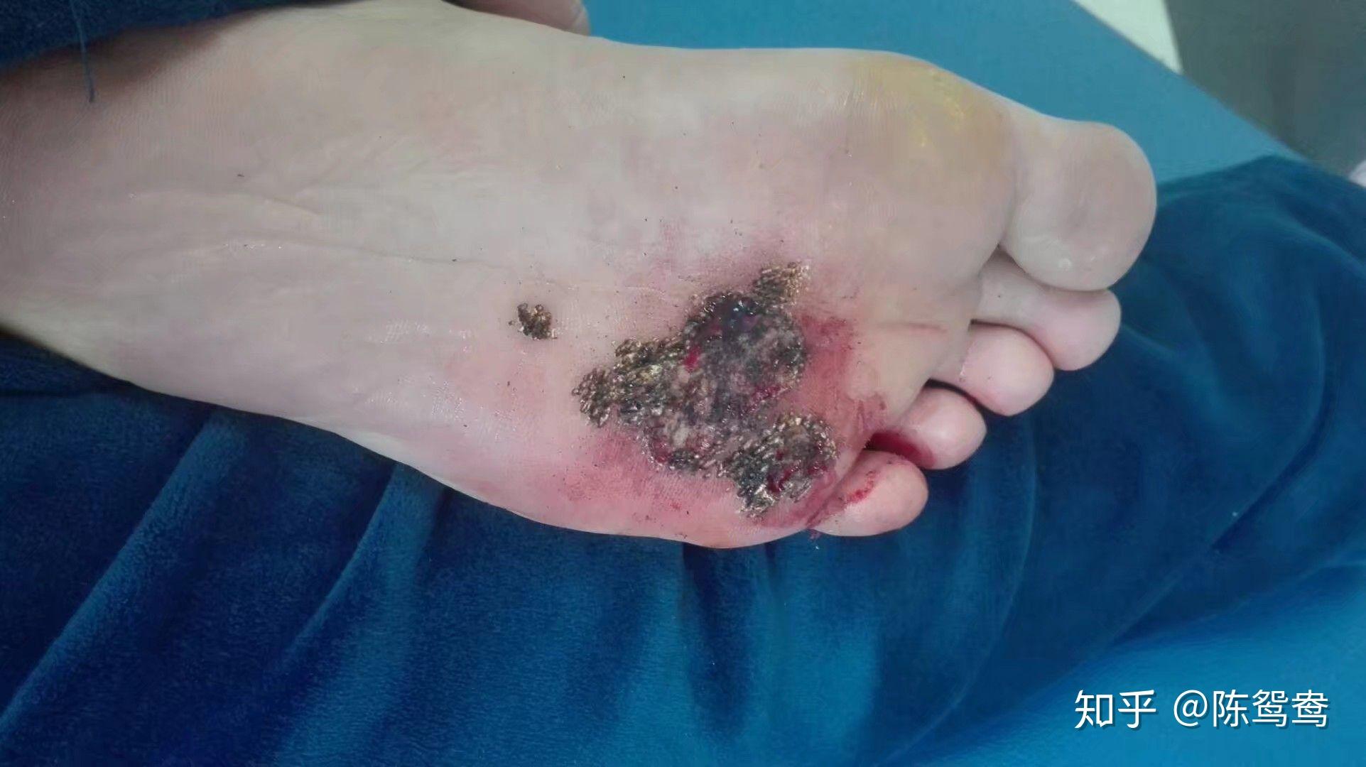 得了该死的多发性跖疣与之对抗的心酸历程