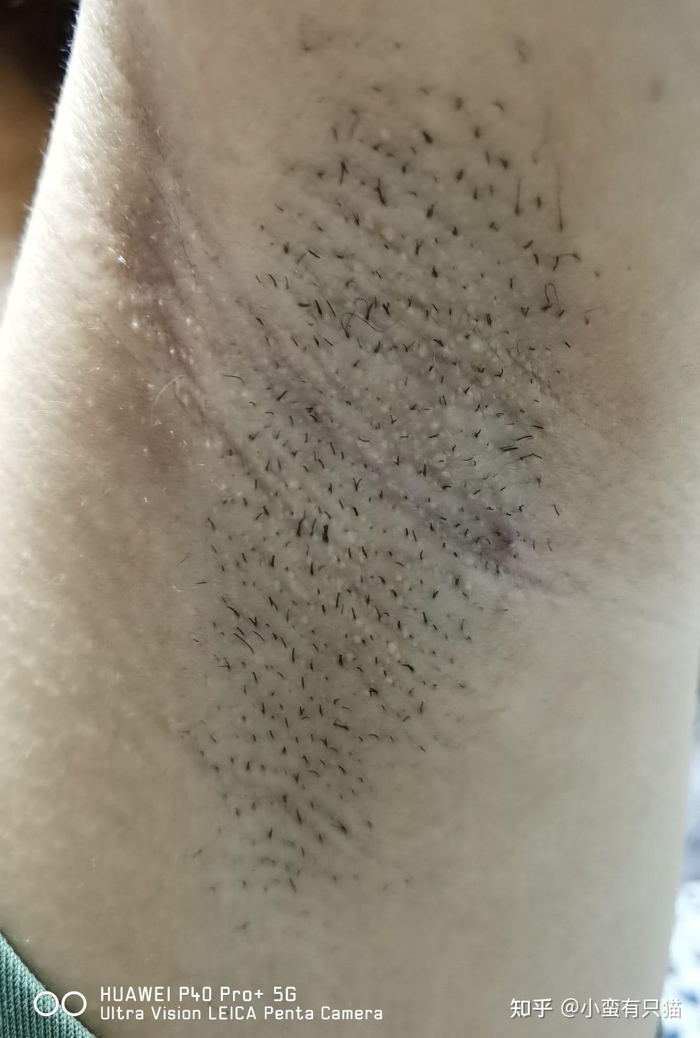 amiro pro脱毛仪的个人使用记录