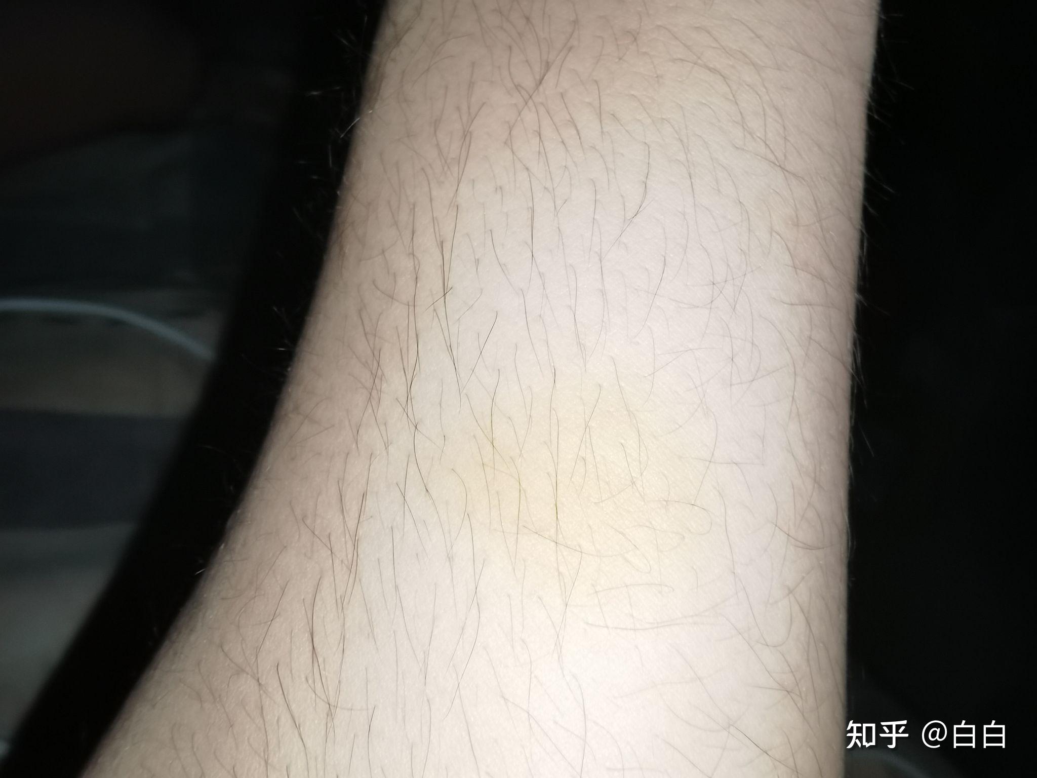 皮肤突然出现黄块