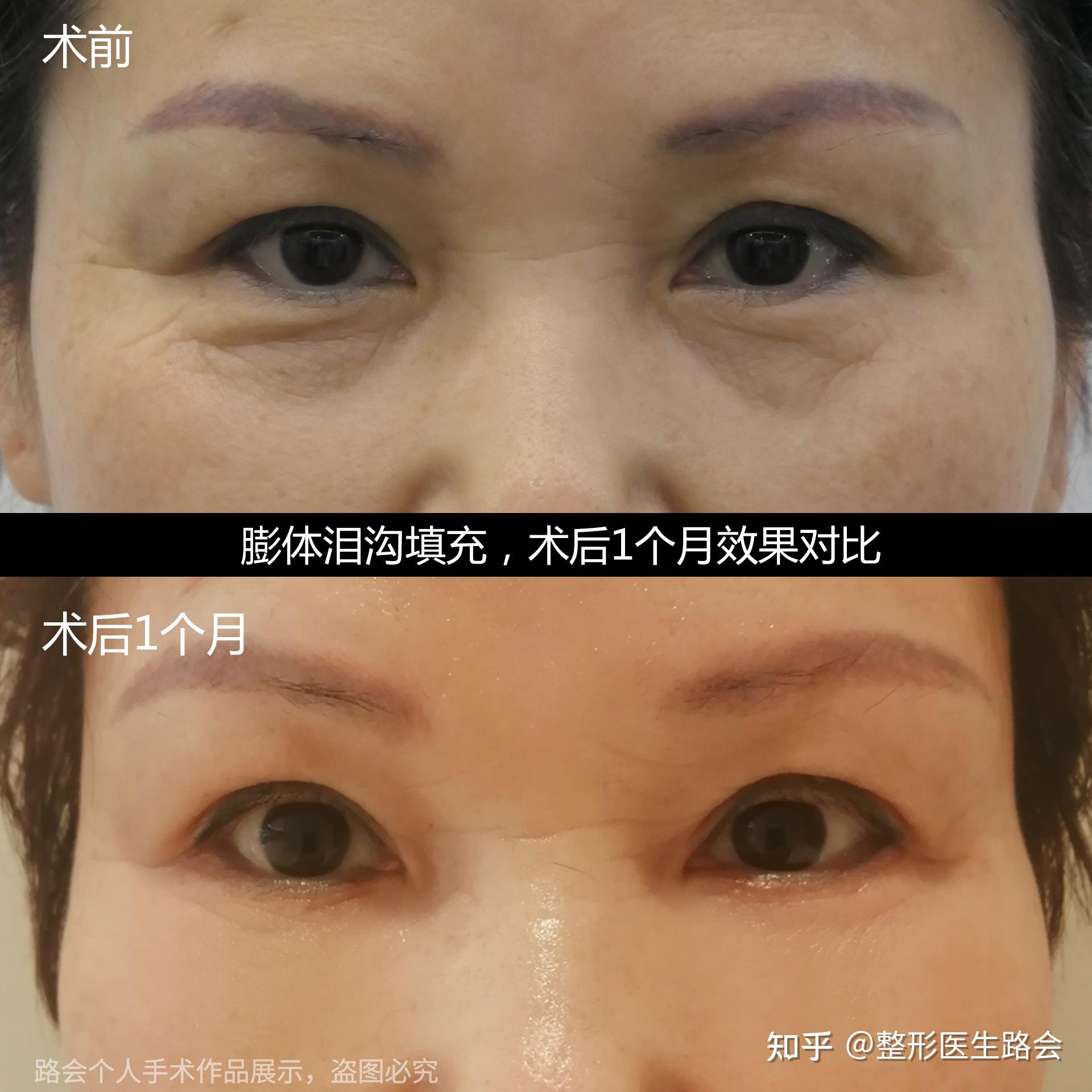 贵州贵阳双眼皮年轻化手术+外切眼袋眶隔脂肪释放填泪沟手术 - 知乎