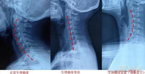 颈椎反弓是用牵引好还是颈椎枕好 知乎