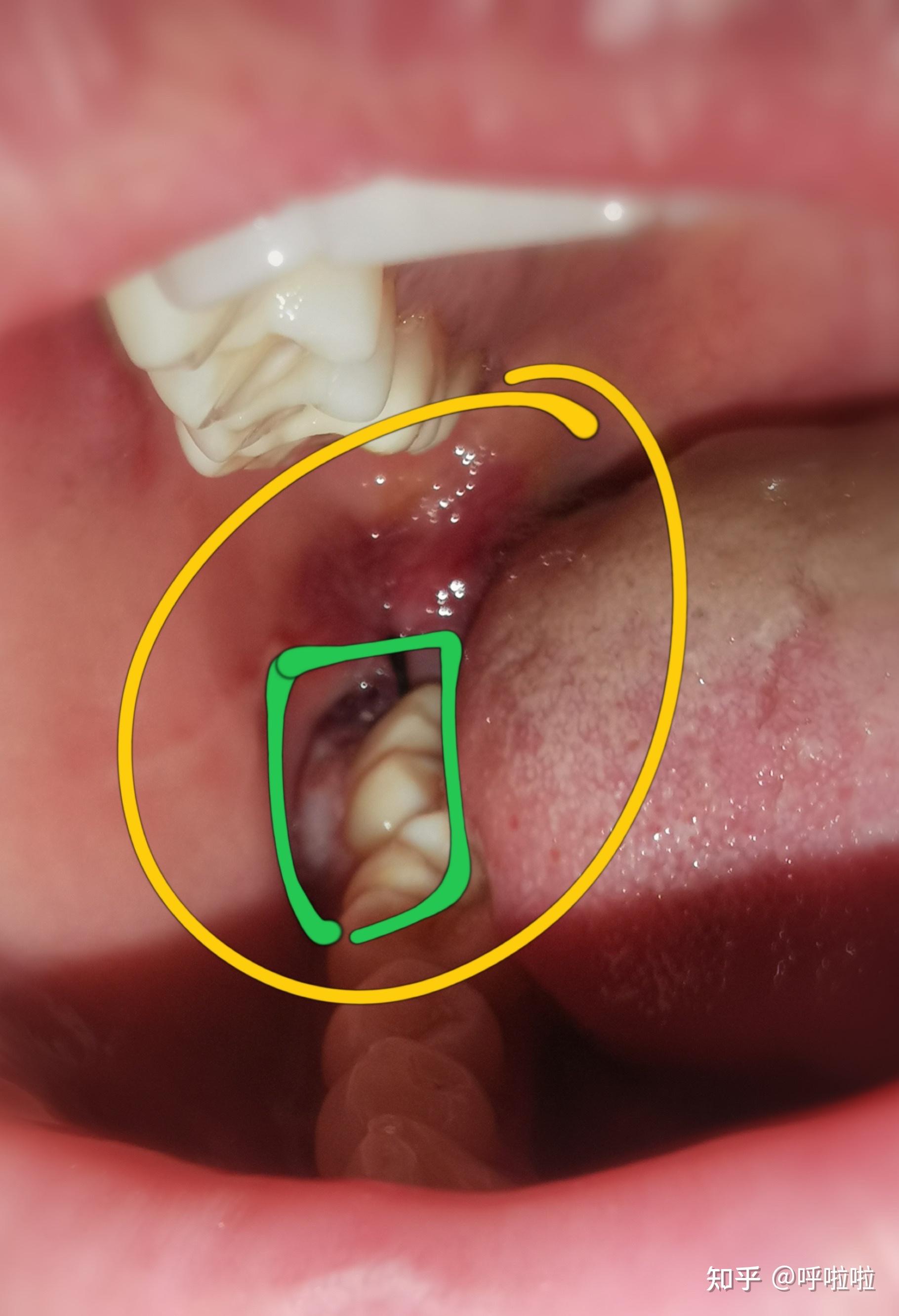 拔智齿全过程一个字疼