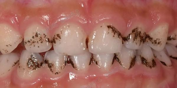 牙齿出现黑斑,像是污渍,却抠不掉刷不掉,这是怎么回事?