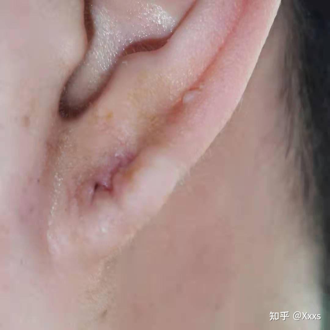 耳垂长了瘢痕疙瘩,记录术后恢复