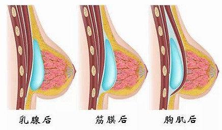 异物取出,胸,鼻高难度整形修复界专家 67 医疗服务 广东美恩整形