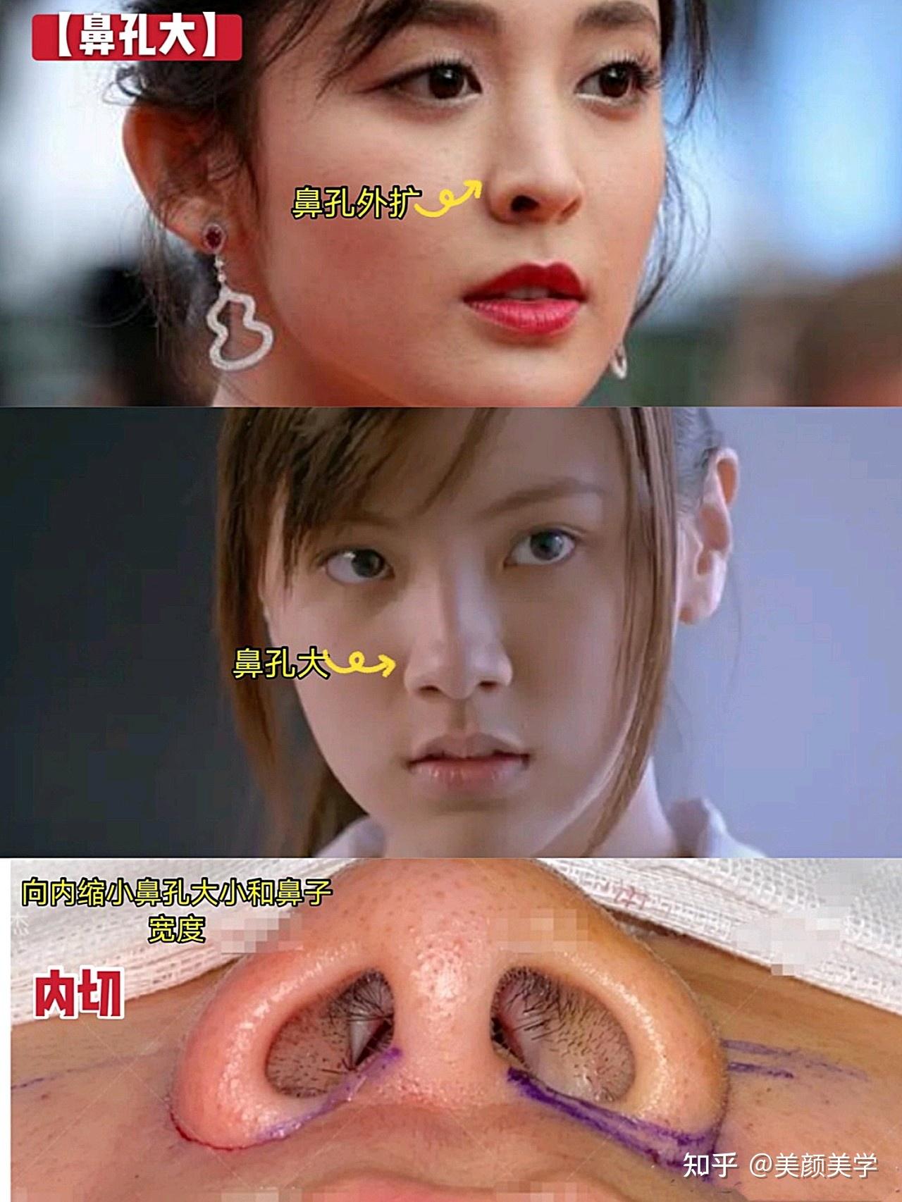 35岁山东姑娘想改善大鼻头，不切鼻翼也能变得很漂亮！ - 知乎