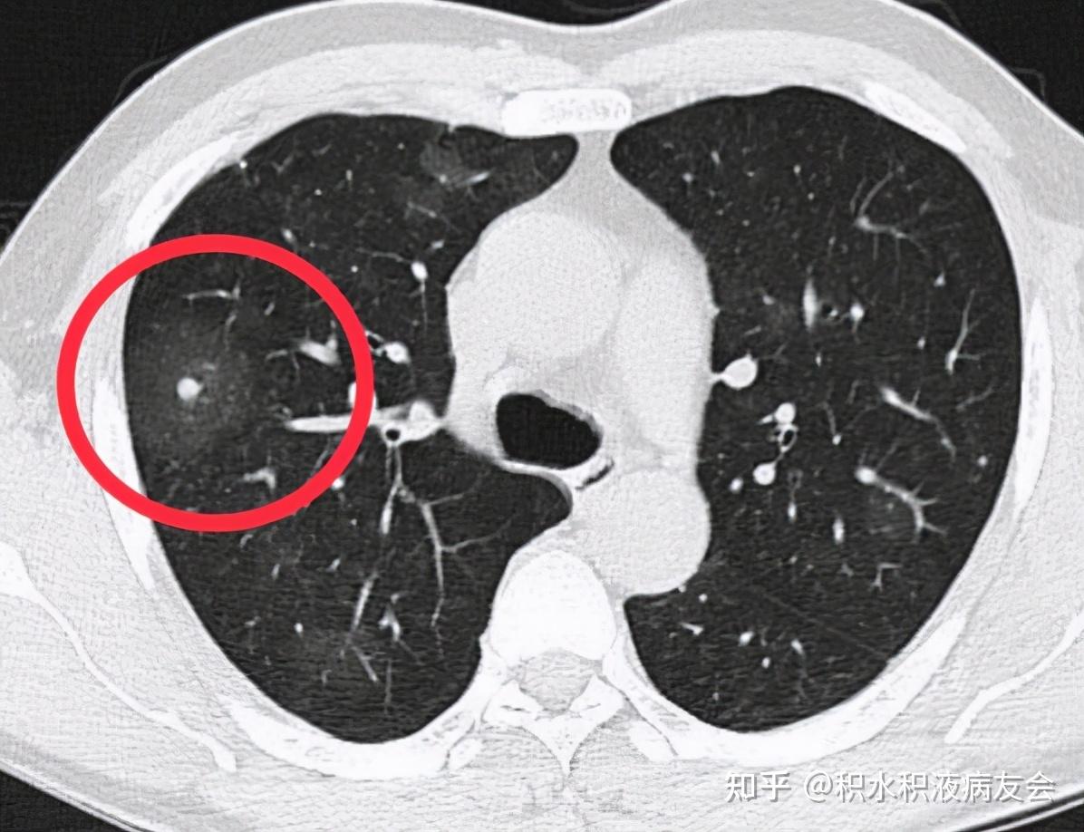 早期肺癌ct图片图解图片