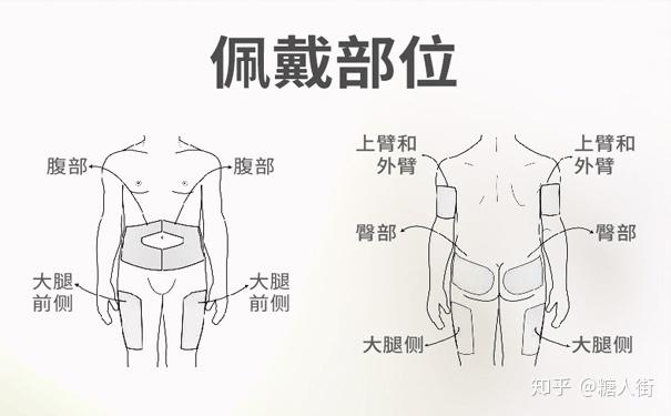 胰岛素泵打针部位图图片