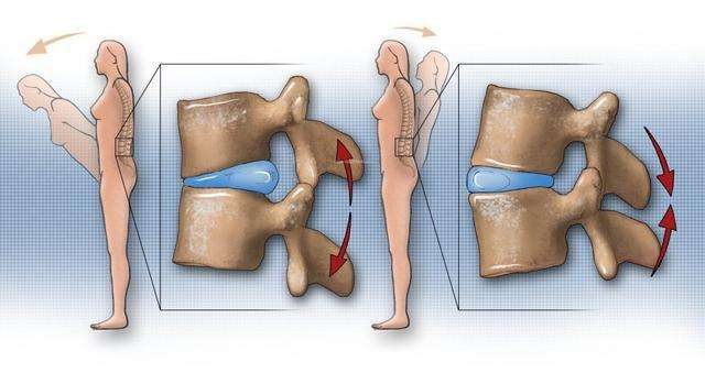 另外,臥床姿勢並沒有嚴格限制,但側身時可以把一條腿曲起,減輕椎間盤